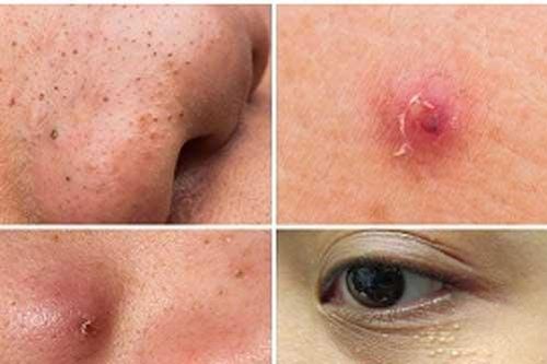 4 loại mụn chớ có dại mà đưa tay lên nặn kẻo nguy hiểm tính mạng