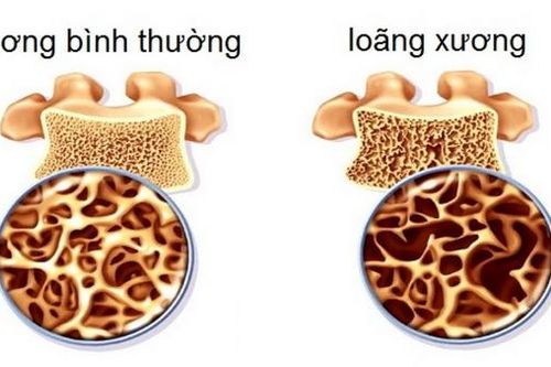 Loãng xương sớm chẳng chừa ai