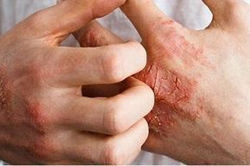 Thuốc ức chế IL-23 chọn lọc đầu tiên trị viêm khớp vảy nến