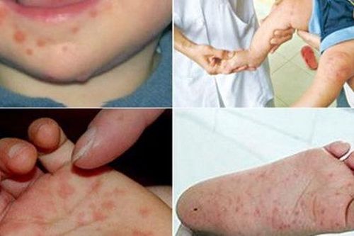 7 biện pháp kiểm soát dịch tay chân miệng