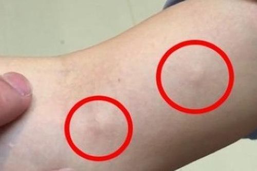 Bác sĩ ấn nhẹ đã thấy tay cô gái nổi nhiều u nang, bạn trai khiếp sợ hỏi có thể kết hôn không, bác sĩ giải đáp thế này