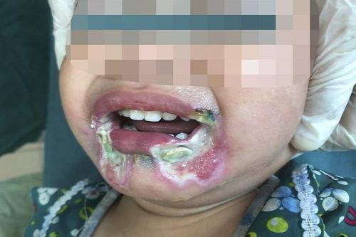 Cắn dây điện, bé gái 2 tuổi bị bỏng miệng hoại tử cằm