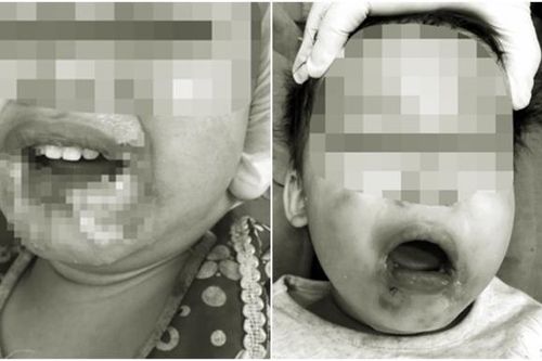 Cắn dây điện, bé 2 tuổi bị hoại tử miệng