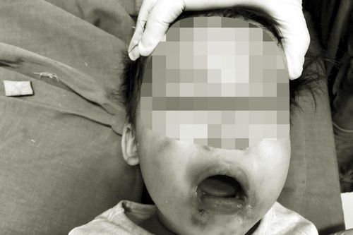 Cắn dây điện khi ngồi chơi, bé gái 2 tuổi ở Yên Bái bất tỉnh, nhập viện khẩn cấp