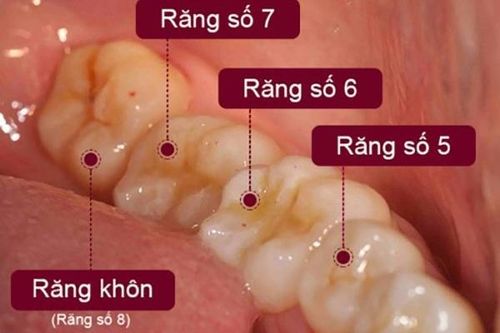Đừng chủ quan khi nhổ răng khôn