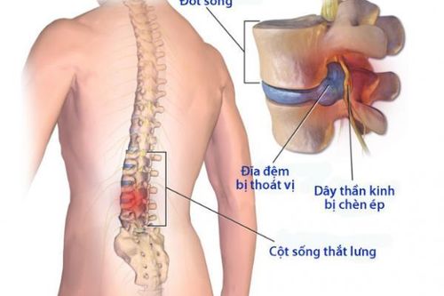 Hậu quả và các biến chứng của bệnh thoái hóa cột sống lưng và cột sống cổ