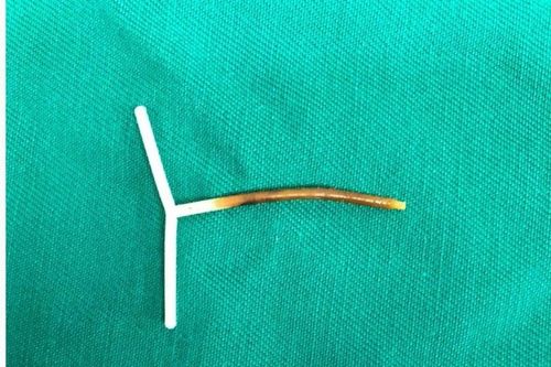Vòng tránh thai hình chữ T xuyên thủng đại tràng