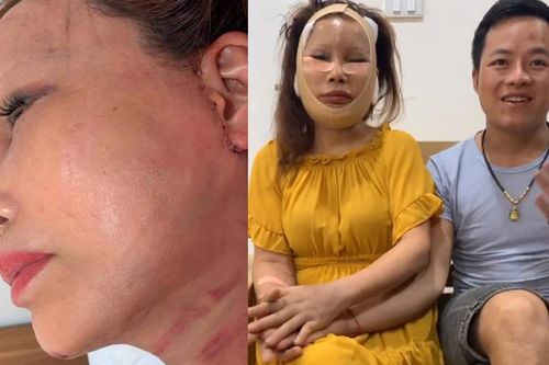 Nhan sắc sau 1 tháng phẫu thuật của cô dâu '62 tuổi' ở Cao Bằng: Sẹo chằng chịt, mặt sưng phù