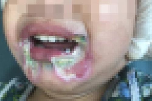 Bé gái 2 tuổi bỏng nặng vùng miệng do cắn dây điện, cảnh báo sự bất cẩn của người lớn vô tình hại trẻ