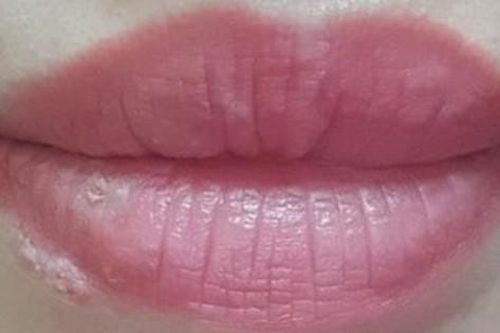 Xăm môi được 3 ngày thì bị mụn rộp herpes ở môi, 2 tuần sau tổn thương toàn thân: 3 nguy cơ có thể gặp sau khi phun xăm bác sĩ muốn mọi người cần biết