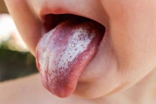 Cảnh báo sức khỏe qua màu lưỡi
