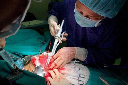 Sự nguy hiểm của ung thư gan thứ phát