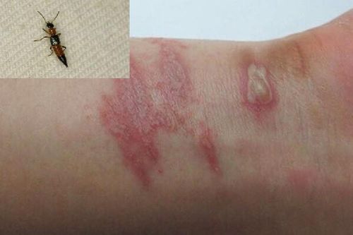 Làm gì khi bị kiến ba khoang đốt? Lắng nghe hướng dẫn xử lý từ chuyên gia