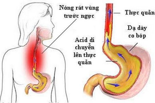Trào ngược dạ dày - thực quản gây ho nhiều, vì sao?