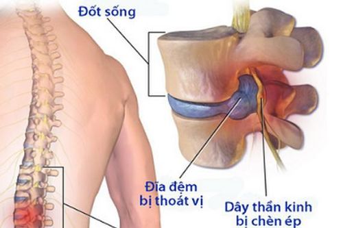 Thoát vị đĩa đệm: khi nào nên mổ?