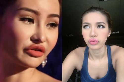 Đang yên lành, hội mỹ nhân Việt lại đua nhau 'bơm môi' tều dầy cộp tức mắt