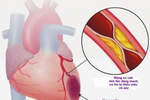 Chất chủ vận thụ thể GLP-1 cải thiện biến cố tim mạch