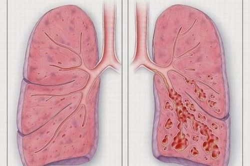 Cảnh báo xơ phổi – di chứng của COVID-19