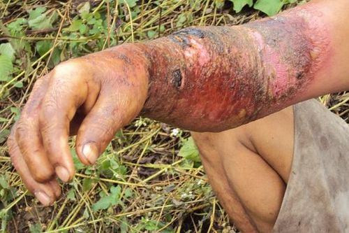 Triển khai dự án nghiên cứu về bệnh than và bệnh Brucellosis (sảy thai truyền nhiễm)