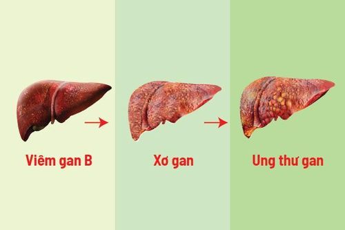 Ngăn chặn 'kẻ giết người thầm lặng' viêm gan virus, xơ gan