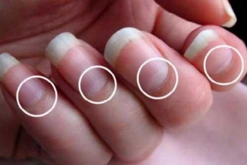 Móng tay xuất hiện dấu hiệu này báo hiệu sức khỏe đang gặp trở ngại, bạn nên đi kiểm tra sớm