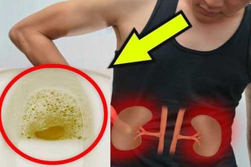 Thấy nước tiểu chuyển sang màu này, hãy cẩn thận vì căn bệnh nguy hiểm đang 'gõ cửa'