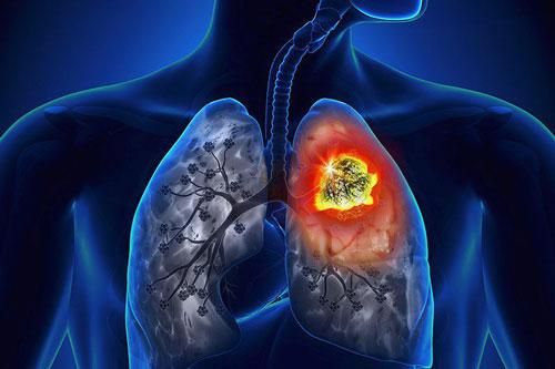 Ung thư phổi và những yếu tố nguy cơ