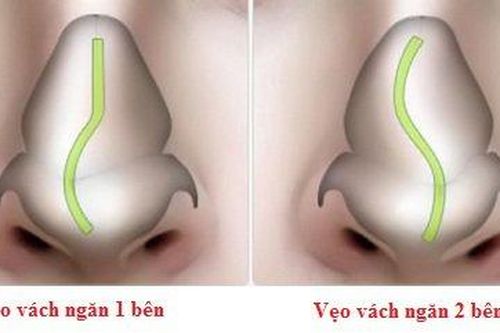 Xử trí vẹo vách ngăn mũi