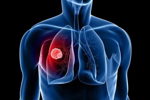 Ho sù sụ quá một tuần không khỏi: Hãy gặp bác sĩ ngay vì có thể bạn đã mắc căn bệnh nguy hiểm này