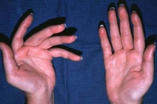 Đại dịch COVID-19: Lo âu làm gia tăng tái phát bệnh đa xơ cứng
