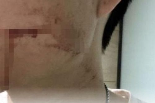 26 tuổi chết sau 10 ngày nhổ răng khôn, chuyên gia chỉ rõ nguyên nhân khiến nhiều người nhầm tưởng