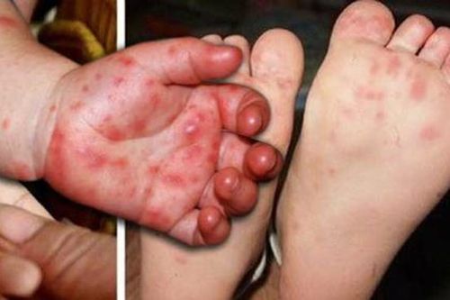 Nhận biết dấu hiệu nặng của bệnh tay-chân-miệng