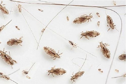 Có thuốc nào trị chấy?