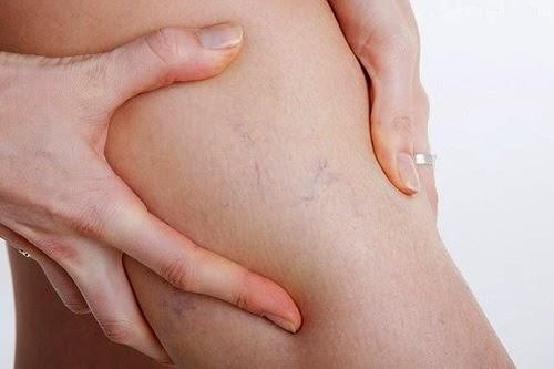 Chân nổi gân xanh, bệnh gì?