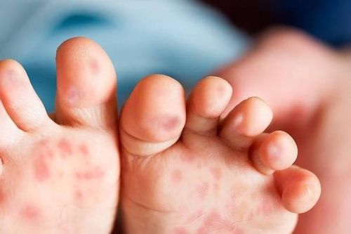 Dinh dưỡng phù hợp để bệnh tay - chân - miệng nhanh lui