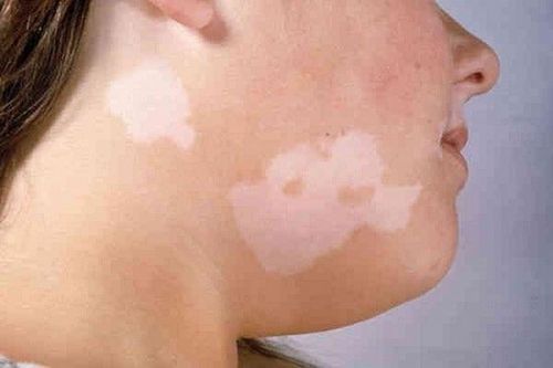 Thay đổi màu da - cảnh giác với bệnh bạch biến