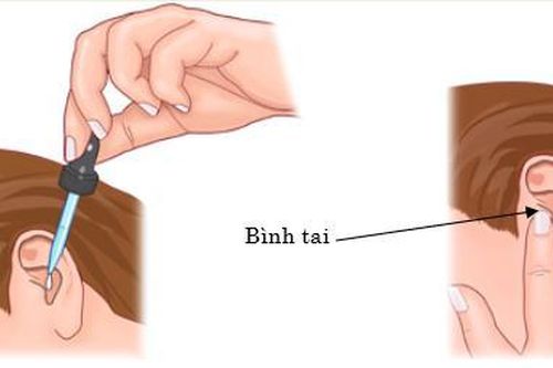 Nước muối sinh lý có tác dụng trong trường hợp đau tai?