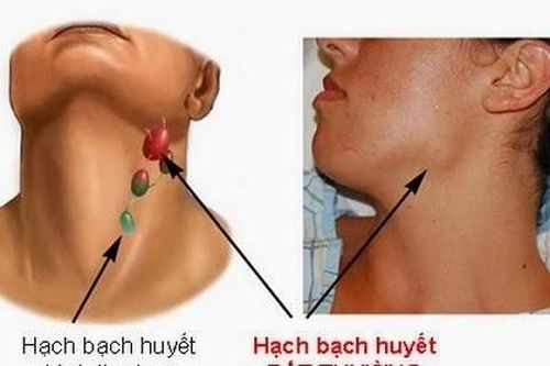 Thuốc mới trị u lympho dòng tế bào B lớn lan tỏa