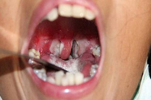Không chủ quan trước bệnh bạch hầu
