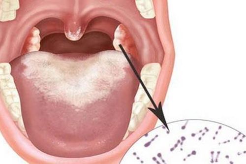 Những điều cần lưu ý khi dùng thuốc trị bạch hầu