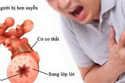 Chăm sóc bệnh nhân hen mắc bệnh tim mạch