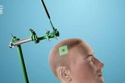 Sử dụng sóng siêu âm để chẩn đoán ung thư não