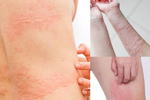 Bỏ túi 5 cách trị dị ứng mề đay do thay đổi thời tiết
