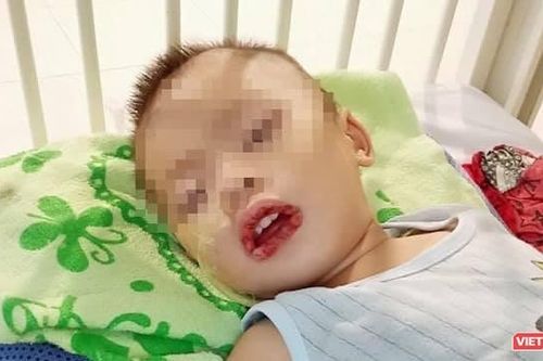 Uống nhầm thuốc tẩy bồn cầu, bé trai gặp hậu quả nghiêm trọng