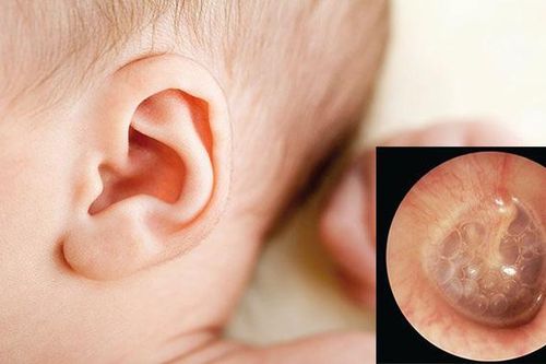 Điều trị viêm tai giữa có mủ như thế nào?