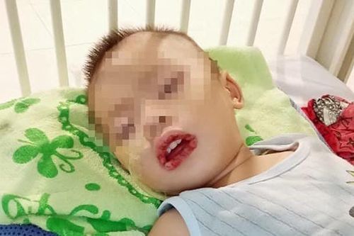 Làm gì khi trẻ lỡ nuốt phải hóa chất?