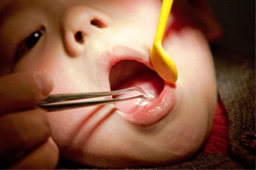 Cầm mặt dây chuyền chơi, bé gái nuốt luôn vào bụng