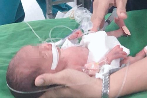 Cứu bé sinh non bị thủng ruột