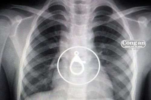 Trẻ nhỏ nuốt móc khóa