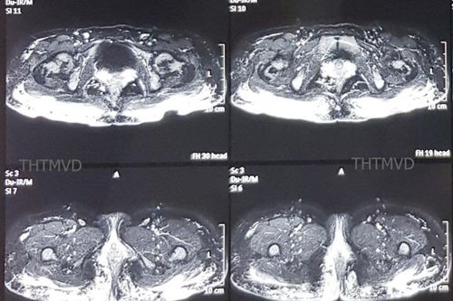 Hoại tử vòng 3 do tiêm mỡ làm đẹp